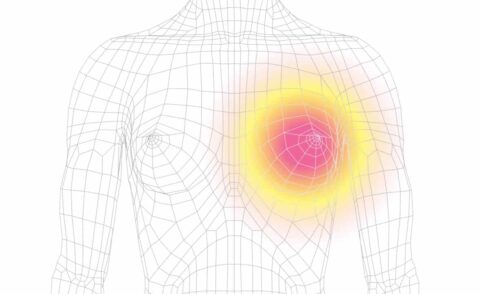 Managing Your Breast Cancer Risk