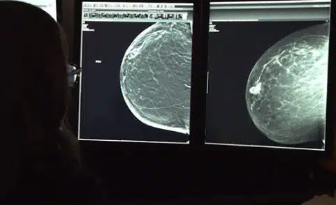 What’s the Best Cancer Screening for Women with Dense Breasts?